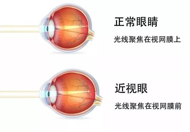 真性近视当然就是眼轴变长造成的近视.那什么是假性近视?
