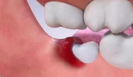 智齿|哪些情况下智齿不用拔除呢？