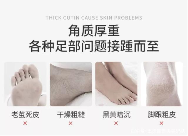 和粗糙腳跟saybye 王權富貴美容護膚將“美腳“進行到底